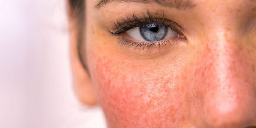 Rosacea: Skin Expert Reveals C...
