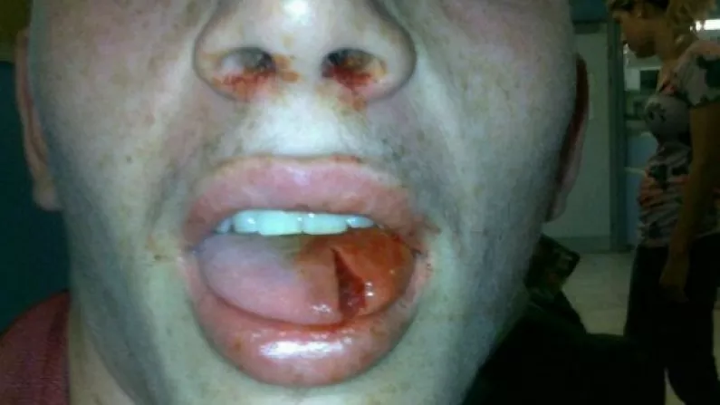 You Will Always Wear A Gum Shield While Playing Rugby After Seeing This Injury.