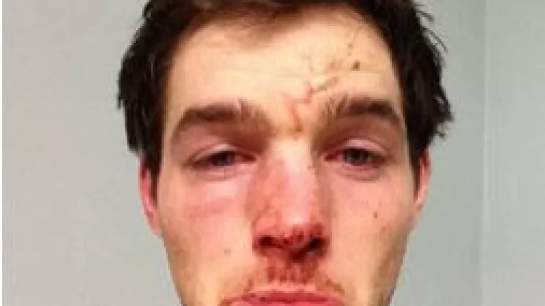 Ger Cafferkey's Face Took A Serious Beating During The Loss To Down At The Weekend.