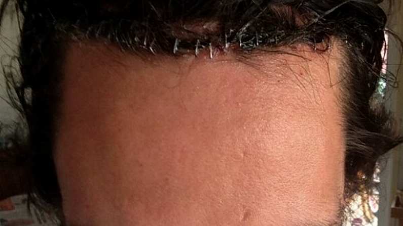 Photo Of Stapled Scalp Of Australian Rugby Union Player Post-Gym Accident