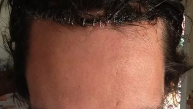 Photo Of Stapled Scalp Of Australian Rugby Union Player Post-Gym Accident