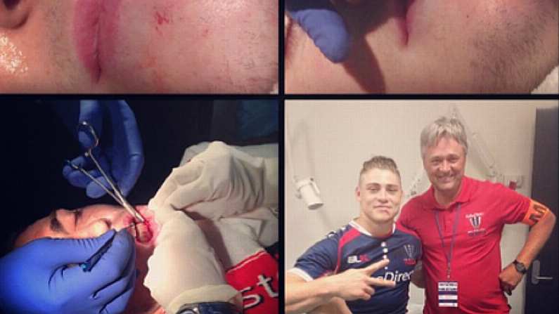 Melbourne Rebels' James O'Connor Sustains Nasty Cut In Preseason Game.