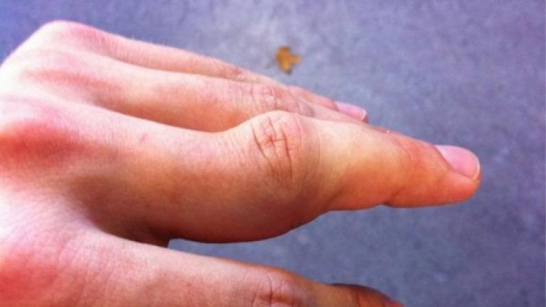 Warning. This Picture Of Sam Warburton's Finger Is Not Pretty.