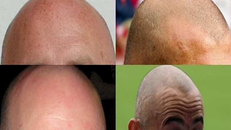 Our Big Shiny 'Guess These Sports Stars From Their Bald Head' Quiz