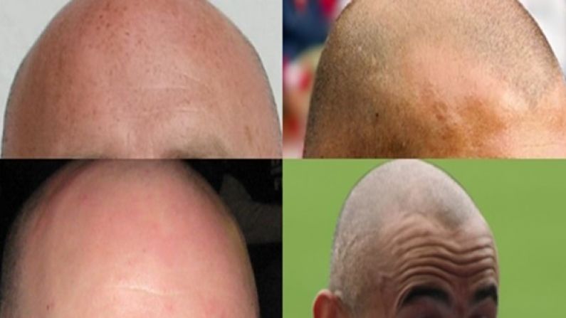 Our Big Shiny 'Guess These Sports Stars From Their Bald Head' Quiz