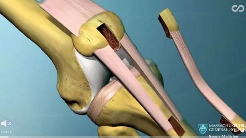 Watch: Fascinating Clip Shows Exactly How The Dreaded ACL Injury Is Repaired