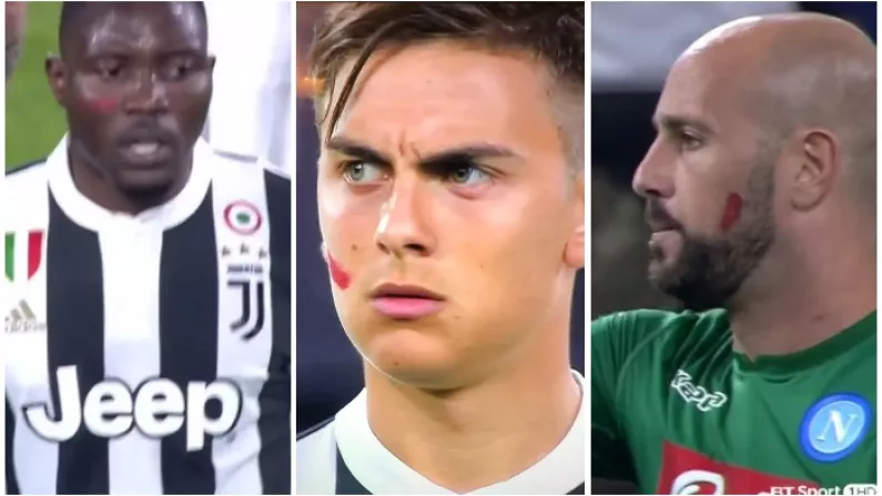 The Brilliant Reason Why Juventus And Napoli Have Red Marks On Their Face