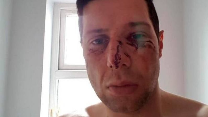 Sean Cavanagh Says He Remains 'Heavily Concussed' Following Facial Injury