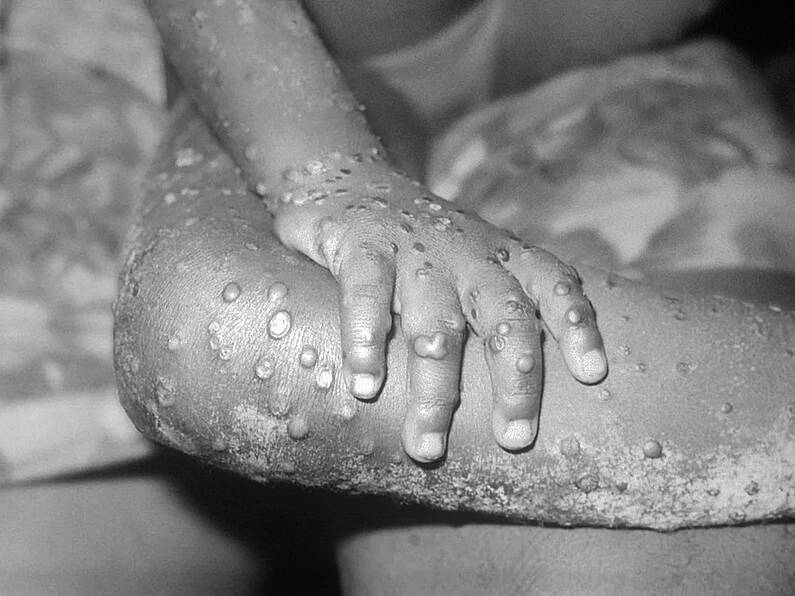 Monkeypox 'likely' to reach Ireland, says tropical disease expert