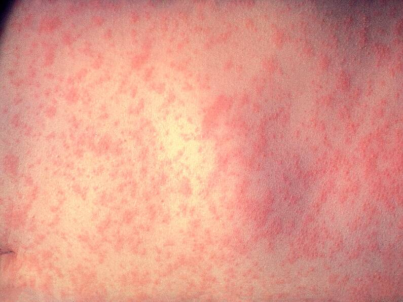 Adult with measles dies in Leinster, according to HSE