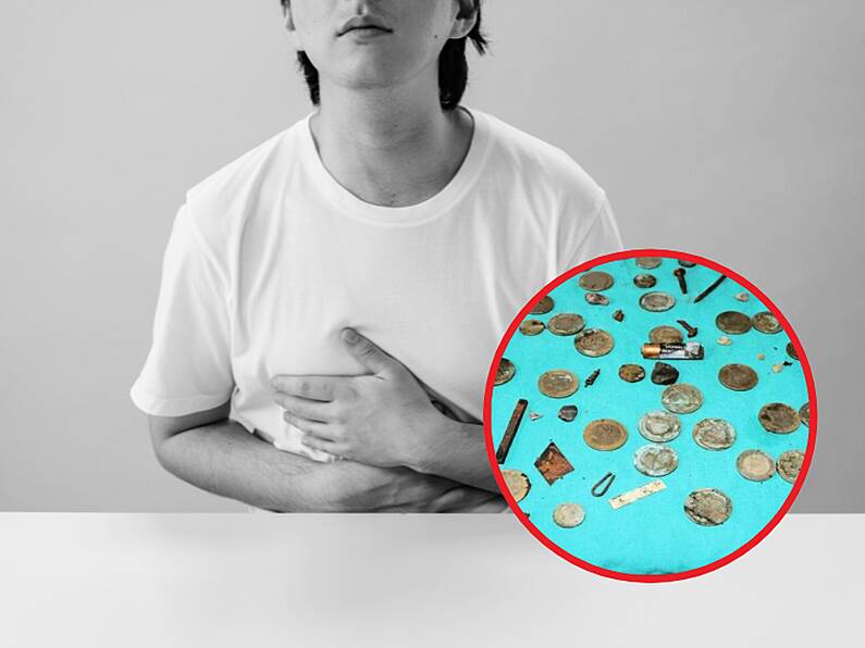 Hundreds of screws, batteries and coins found in man's stomach leaves doctors mind blown!