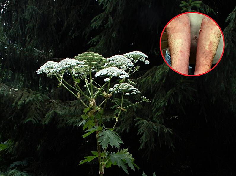 Tipperary teenager left in hospital after being burned by 'most dangerous plant in the UK'