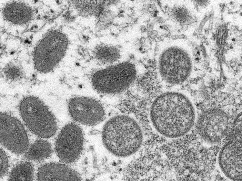 Second monkeypox case confirmed in Ireland