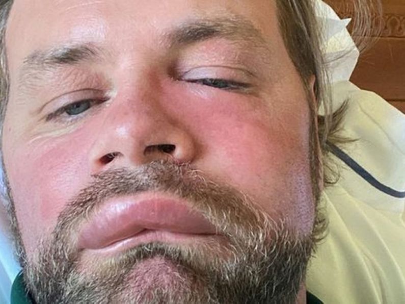 Brian McFadden suffers severe allergic reaction to bee sting