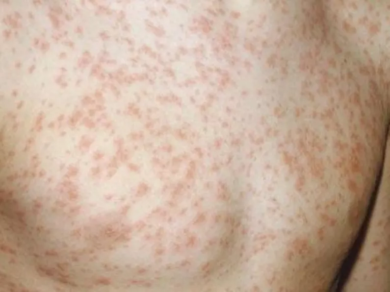 HSE warn of further measles outbreak among adults and children