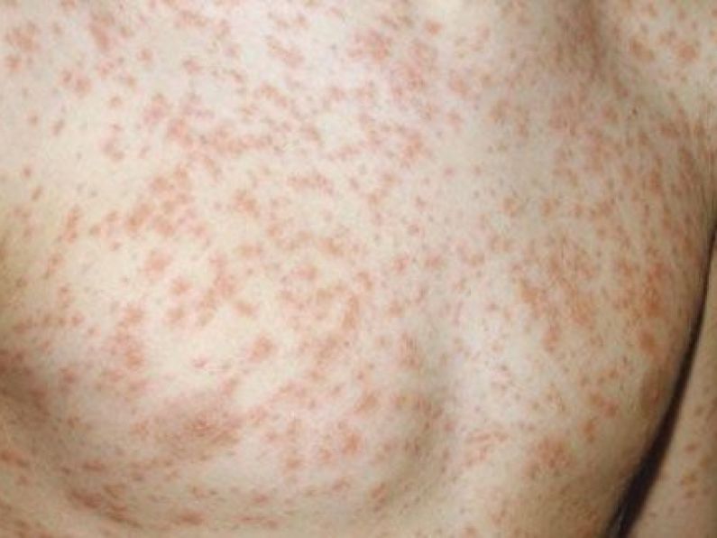 Parents warned over outbreak of measles in Dublin area