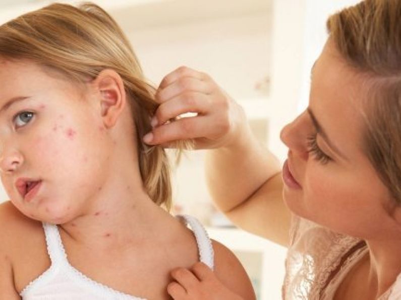 Measles cases in Ireland increased by 244% in 2018