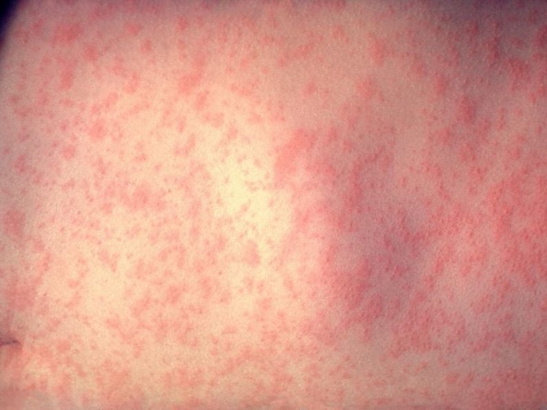 Adult with measles dies in Leinster, according to HSE