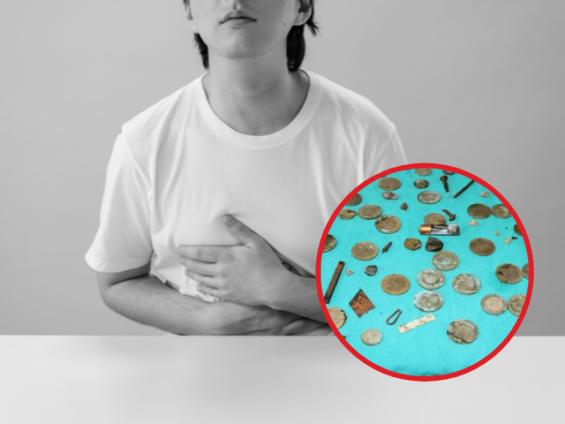 Hundreds of screws, batteries and coins found in man's stomach leaves doctors mind blown!