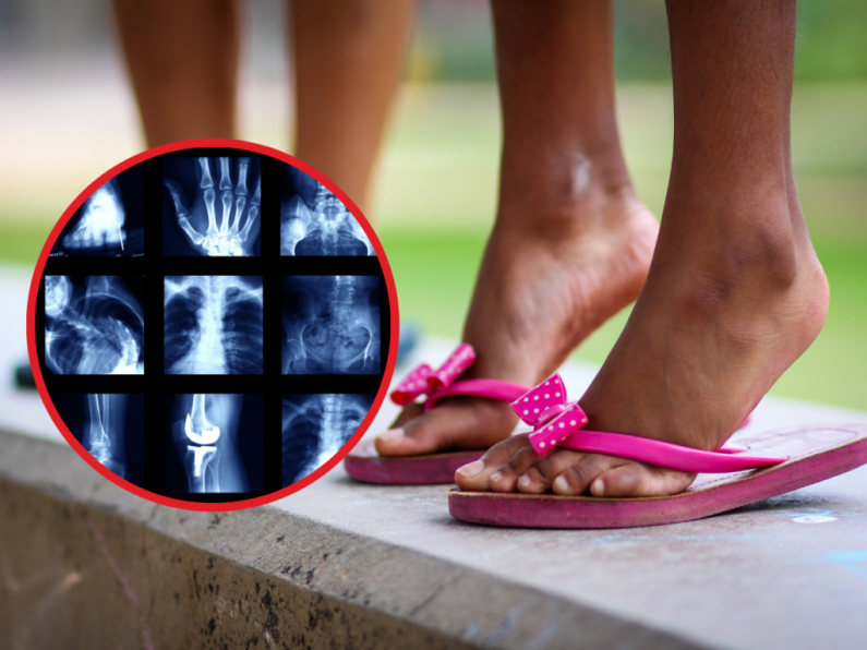 Flip-flops crowned most dangerous summer wear