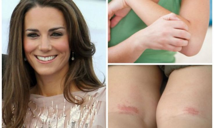 What's flaky, itchy and red all over? Battling the demon eczema