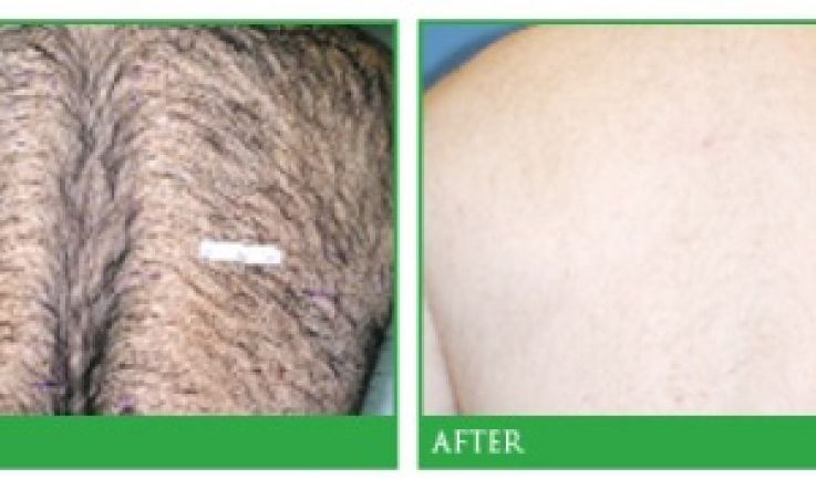 Starlux Laser at the Berkeley Clinic: takes the outch out of hair removal