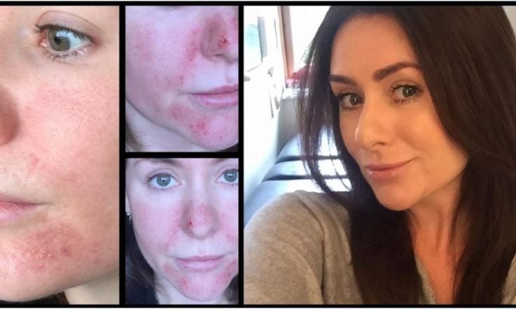 We tried Fraxel skin resurfacing and here's what happened (raw skin and all)