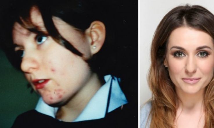 Facing My Fears: A personal account of living with acne