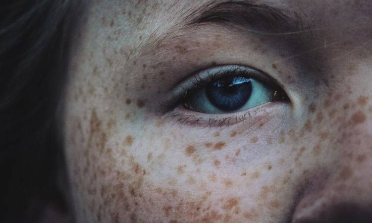 Freckles are 'imperfections' according to Match.com