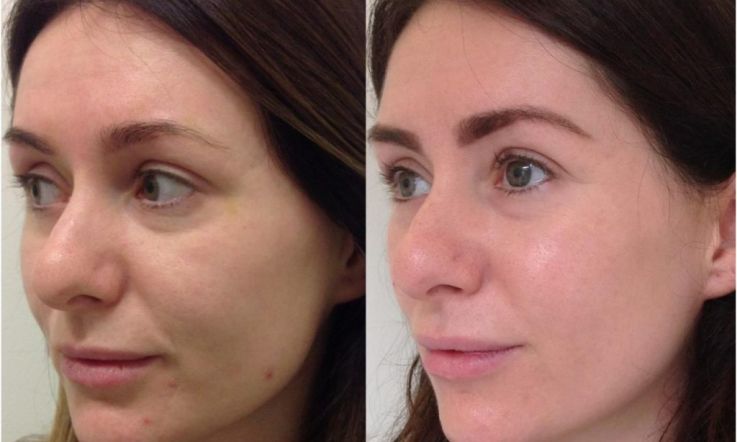 The Skin Quest: Our Beauty Editor's 6 month journey towards clearer skin