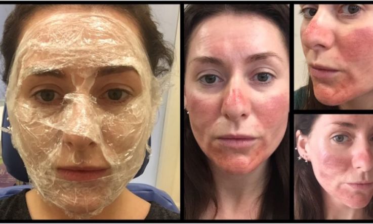 Skin Quest: RF Resurfacing at the Clear Skin Clinic