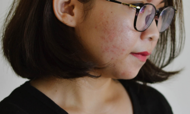 How to treat acne scarring