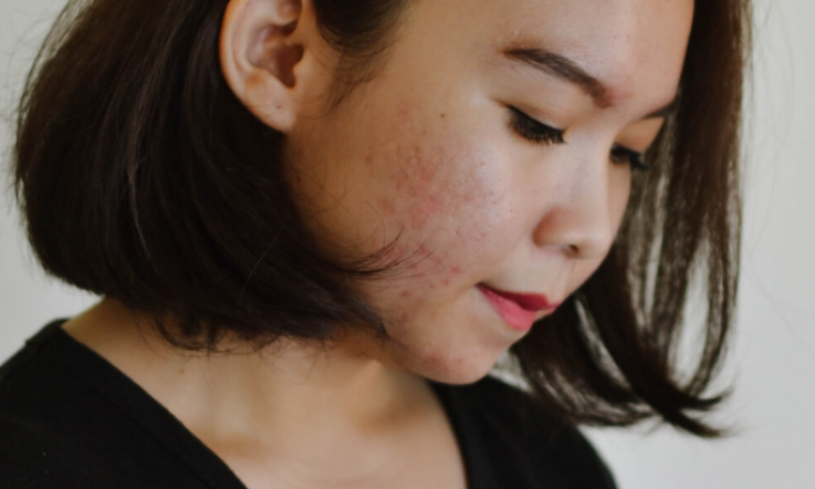 What Is The "Skin Positivity" Movement And Why Is It Important?