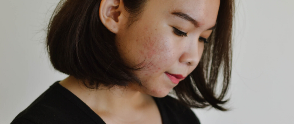 What Is The "Skin Positivity" Movement And Why Is It Important?