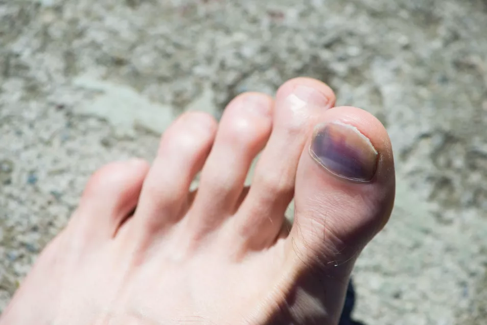 bruised toe nail