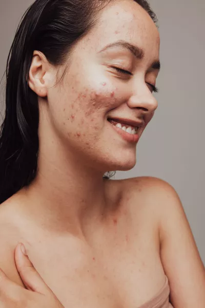 Close up of smiling woman with acne