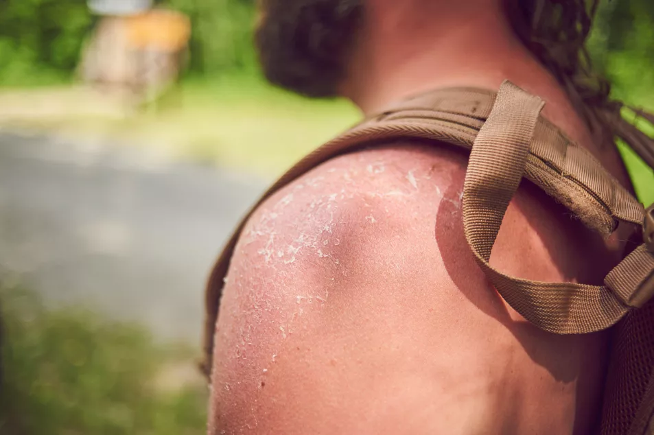 man with sunburned peeling shoulders
