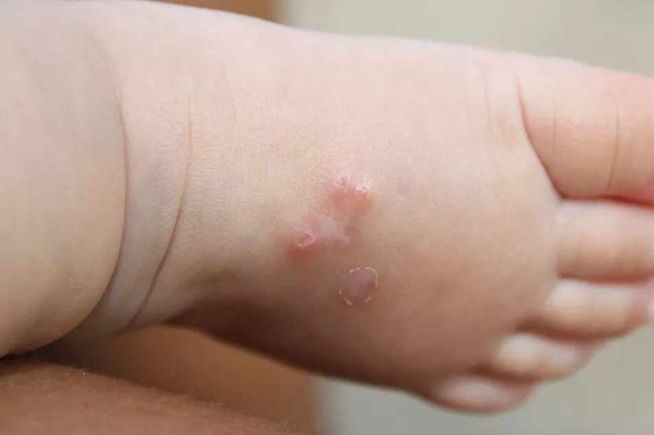 Baby's foot with scabies rash 