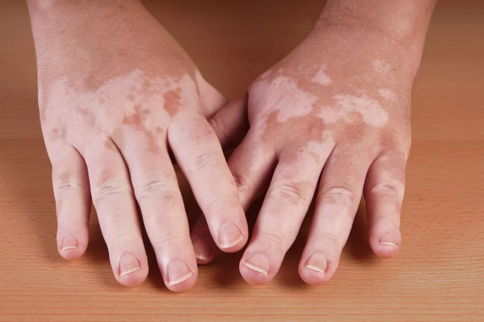 A close of someone's hand who has vitiligo