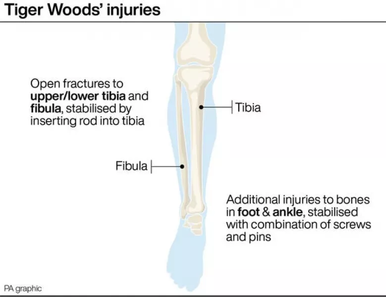 The injuries Woods suffered in his car crash (PA Graphics)