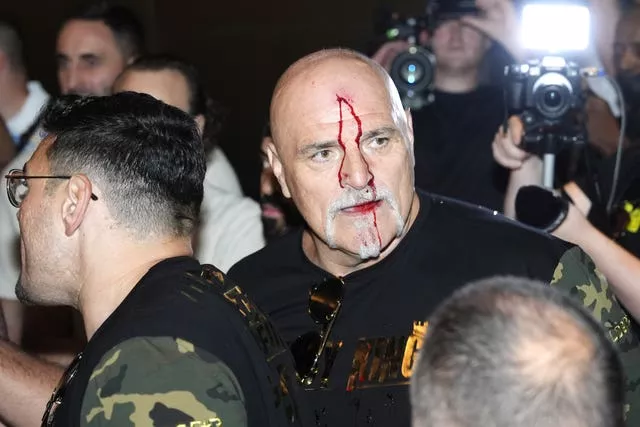 Tyson Fury's father John Fury with blood on his face after a pre-fight altercation with Oleksandr Usyk's camp
