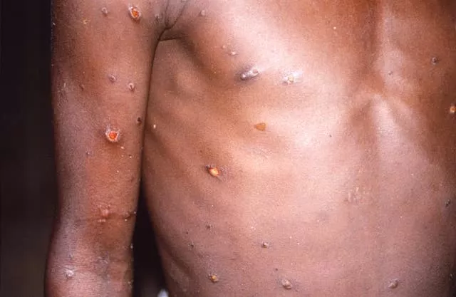 Monkeypox on skin