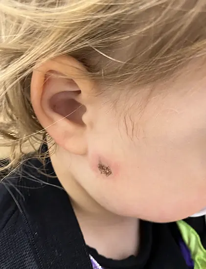 Firework Thrown Into Garden Hits Two-Year-Old In Face