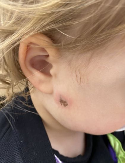 Firework Thrown Into Garden Hits Two-Year-Old In Face