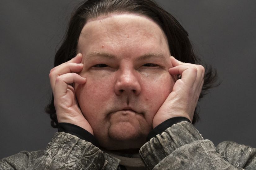 Man Who Was Burned In Car Crash Receives ‘Phenomenal’ Face And Hands Transplant