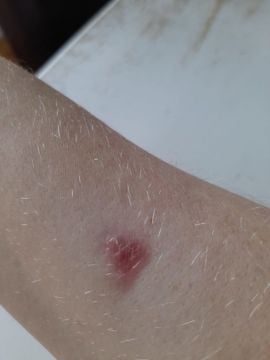 What Does A False Widow Spider Bite Look Like : Reaction To False Widow