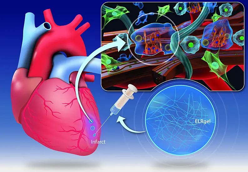 Researchers In Ireland Develop Gel To Repair Heart Muscle After Heart Attack