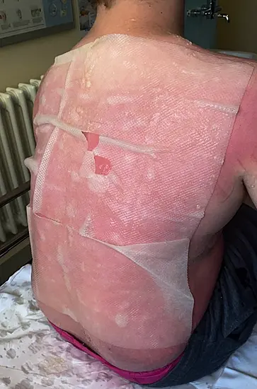 Mother Issues Warning After Son Suffers Second-Degree Burns Despite Suncream