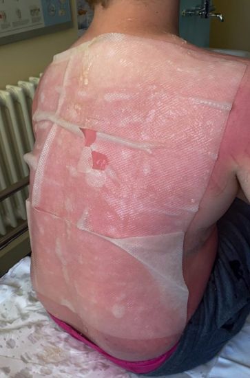 Mother Issues Warning After Son Suffers Second-Degree Burns Despite Suncream