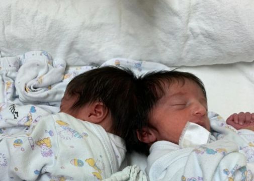 Conjoined Twins Separated In 12-Hour Surgery In Israel